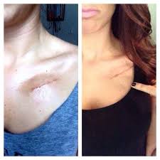 Cardiac problems are the leading cause of death worldwide. I Ve Had A Pacemaker Since I Was 7 This Was My Third Replacement 2 Weeks After Surgery And Then 6 Weeks After My First Two Pacemakers Were Buried Pretty Deep So When