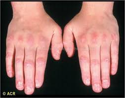 Pin On Dermatomyositis The signs and symptoms of dermatomyositis can appear suddenly or develop gradually over time.