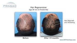 Male pattern baldness laser treatments. Aggressive Male Pattern Hair Loss Without Finasteride Ny Hair Loss