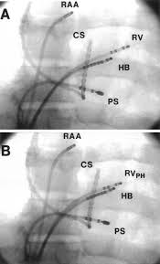 Para-Hisian Pacing