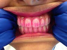 Karang gigi juga bisa terbentuk dari bawah gusi dan bisa menyebabkan iritasi pada gusi. Dental Plaque Wikipedia