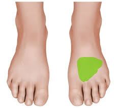 Metatarsal Stress Fracture Diagnosis Stress Fracture Metatarsal Fracture Meniscus Tear