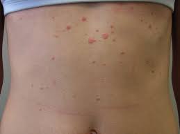 Image result for psoriasis
