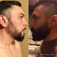 Before and after photos from real minoxidil products user: Some Information On Minoxidil Beards Beards
