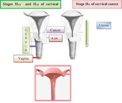 Cervical cancer symptoms tend to show in cases of advanced cervical cancer. Frontiers Cervical Cancer Different Treatments And Importance Of Bile Acids As Therapeutic Agents In This Disease Pharmacology