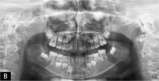 The aneurysmal bone cyst (abc; Percutaneous Embolization Of Aneurysmal Bone Cyst Of The Mandible A 3 Year Follow Up Sciencedirect