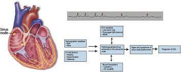 Incidence Of And Risk Factors For Sick Sinus Syndrome In The General Population Sciencedirect