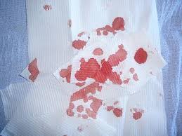 If you wait, blood has iron in it and will rust. Tips For Removing Blood Stains From Fabric Clothing