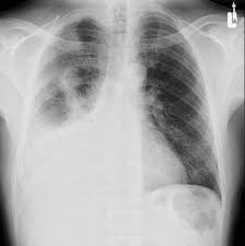 Pleural Effusion Treatment & Management: Approach Considerations,  Therapeutic Thoracentesis, Tube Thoracostomy