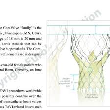 Sizing Recommendations For The Corevalve Evolut And