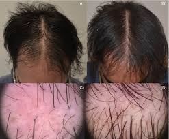 Do you have seborreic dermatitis? Preliminary Results Of The Use Of Scalp Microneedling In Different Types Of Alopecia Starace 2020 Journal Of Cosmetic Dermatology Wiley Online Library