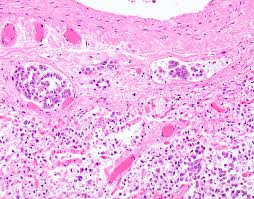 At least in the united states, incidence rates of mpm have remained stable over the last 30 years. Pathology Outlines Diffuse Malignant Mesothelioma