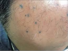 Image result for Blue Nevus