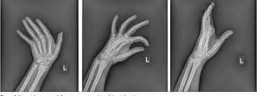 Image result for Pisiform Bone