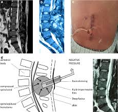 The Classification Of Recurrent Spinal Epidural Hematoma A Review Of The Literature And A Comparison With The Cases Semantic Scholar