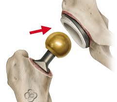 Coxartroza,proteza sold.nu stiu de marci dar stiu de operatie. Proteza TotalÄƒ De Sold Sk S