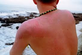 Image result for Sunburn