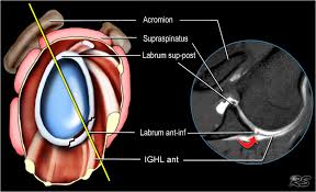 The labrum is a structure that helps stabilize your a labrum is the cartilaginous rim that encircles the socket of the shoulder that the upper arm bones sits in. Shoulder Anatomy Labrum Anatomy Drawing Diagram