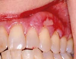 Image result for lichen planus on tongue)