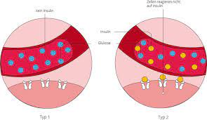 Diabetes Mellitus Ernahrung Und Einfluss Auf Das Herz Cardiosecur