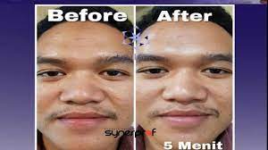 Jika kamu ingin menggunakannya sebagai masker, maka oleskan perasan lemon pada wajah yang terdapat flek hitam. Wa Atau Sms 0852 1118 2605 Cara Menghilangkan Flek Hitam Di Wajah Sudut Bibir Dan Dagu Youtube