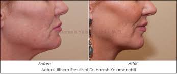 Maybe you would like to learn more about one of these? Get Rid Of Your Turkey Neck Ahb