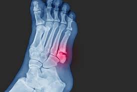 Jones Fracture: What Should You Do? - Sport Doctor London