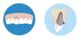 Image result for Tooth Luxation