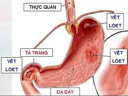 Maybe you would like to learn more about one of these? Dáº¥u Hiá»‡u Sá»›m Ä'iá»ƒn Hinh Nháº¥t Bao Hiá»‡u Dáº¡ Day Bá»‹ Tá»•n ThÆ°Æ¡ng Co Bá»‡nh Ä'á»«ng Ä'á»ƒ Biáº¿n Chá»©ng Nguy Hiá»ƒm
