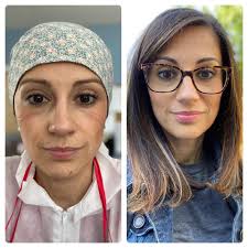 This is Sylwia Faucher, OTA, RD in New Britain, CT. These pictures were  taken 2 months apart. Left picture: 4/17/20 This is Sylwia in the heart of  COVID, working directly with COVID