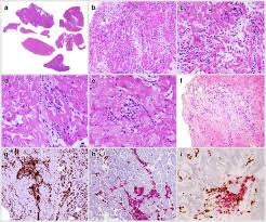 There are four different clinicopathologic classifications of myocarditis — fulminant, acute, chronic active. The Spectrum Of Myocarditis From Pathology To The Clinics Springerlink