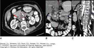 Jun 01, 2021 · pancreatic ductal carcinoma (pdac) is a highly lethal cancer, and early detection and accurate staging are critical to prolonging survival. Accessmedicine S Image Of The Week Ct Findings Associated With Pancreatic Cancer Accessmedicine Network