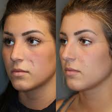 Scars Revision Gallery