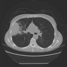 What does ldct stand for in screening? Ldct Lung Cancer Screening Lowers Risk Of Mortality In High Risk Patients North Kansas City Hospital North Kansas City Mo