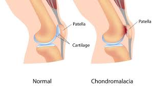 Tumor lutut adalah gejala dari banyak patologi sistem muskuloskeletal. Ternyata Ini Penyebab Lutut Sakit Saat Naik Tangga