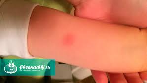 Χρησιμοποίησαν εξασθενημένο στέλεχος του μυκοβακτηρίου των βοοειδών και ονόμασαν το εμβόλιο bcg (βάκιλος των calmette και guérin). To Mikro Mantoux Einai Kalo H Kako Dokimh Mantoux Kanonas 8etikos Arnhtikos