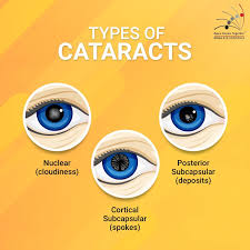 There Are Primarily Three Types Of Cataracts That Can Lead To Loss Of Sight And Reduced Vision Consult With Our Eye Health Facts Optometry Education Eye Facts