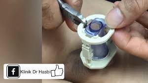 Dua istilah ini sering digunakan bagi menggambarkan lebihan lemak serta perut yang menggeleber. Cara Buka Clamp Khatan Yang Betul Dan Tidak Sakit Klinik Dr Hasbi
