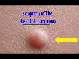 Warning signs of skin cancer on the eyelids a basal cell carcinoma (bcc) extending toward the margin of the lower eyelid. Basal Cell Carcinoma Information