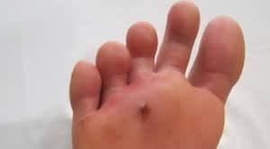 foot puncture wound treatment hints