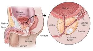 Again, this is most likely not caused by cancer but by other factors such as diabetes. Prostate Cancer Treatment Prostate Cancer Surgery Hospital