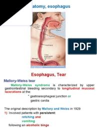 Boerhaave (esophageal rupture) is much more severe and will probably result in death if untreated. Esophagus Tear Esophagus Stomach