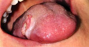 Image result for white cancer on tongue)