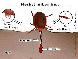 Die bisse der parasiten sind unangenehmer als mückenstiche, es kommt zu. Grasmilben Beim Menschen Herbstgrasmilben Bisse Behandeln
