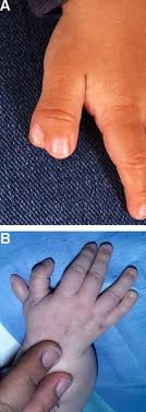 Tell us the details of your dream and find out interpretations, analysis and meanings for it. Acrocallosal Syndrome Medlineplus Genetics