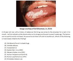 The difference between the herpes viruses. Free Usmle Comlex Practice Questions Doctors In Training