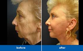 Maybe you would like to learn more about one of these? How To Get Rid Of Turkey Neck With Plastic Surgery Scripps Health