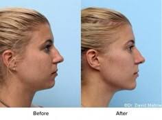 10 Nose job ideas