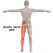 Sciatica Si Durerile De Picior