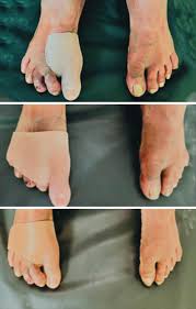 Image result for toe amputation